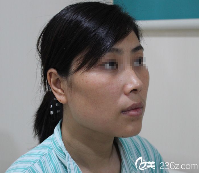 【下頜角+顴骨】一位媽媽做顴骨和下頜角的經歷。