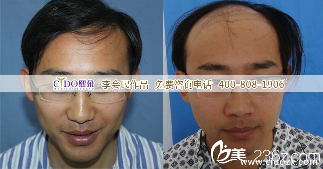 　　丁先生自述：　　我是一名高級工程師。由于遺傳和工作壓力，