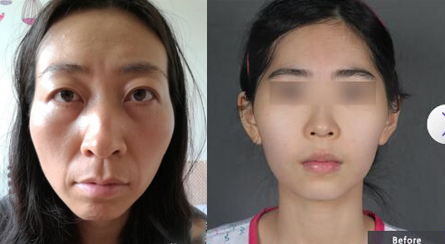 高顴骨太陽(yáng)穴凹陷——韓國(guó)will醫(yī)院——治療方式