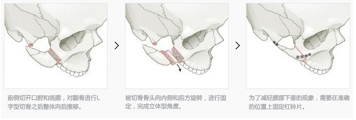 高顴骨—<!--<i data=20240703-sp></i>--><!--<i data=20240703-sp></i>-->—高顴骨截骨方式