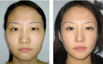 高顴骨太陽(yáng)穴凹陷—韓國(guó)will醫(yī)院—自體脂肪豐太陽(yáng)穴案例