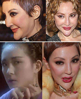 隆下巴失敗案例