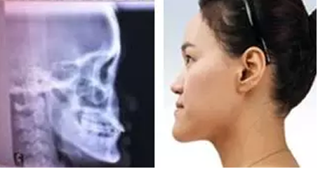 長下巴截骨—韓國灰姑娘醫(yī)院—<!--<i data=20240703-sp></i>--><!--<i data=20240703-sp></i>-->截骨方式