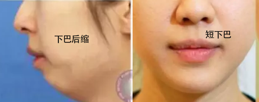 下巴后縮和短下巴的區(qū)別—韓國灰姑娘醫(yī)院—<!--<i data=20240703-sp></i>--><!--<i data=20240703-sp></i>-->