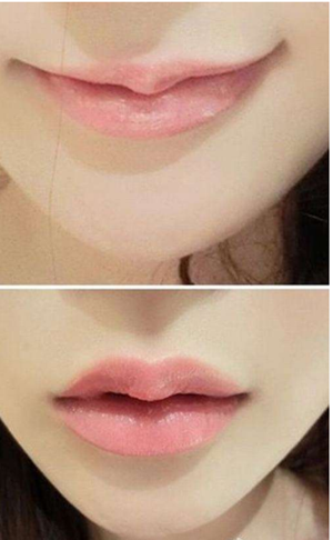 玻尿酸注射豐唇