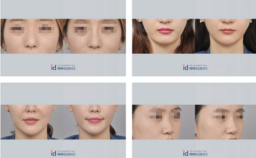 韓國ID醫(yī)院徐榮兌院長(zhǎng)做愛貝芙玻尿酸注射案例