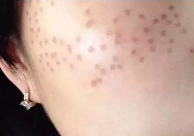 激光祛斑反黑圖片