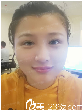 岳陽(yáng)你美整形醫(yī)院雙眼皮真人案例