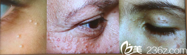 韓國童顏中心—脂肪粒，汗管瘤