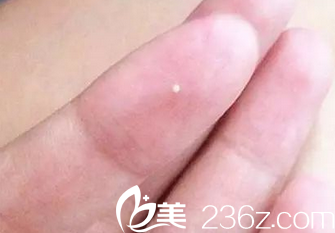 韓國童顏中心—具昭彥院長(zhǎng)——脂肪粒擠出分泌物