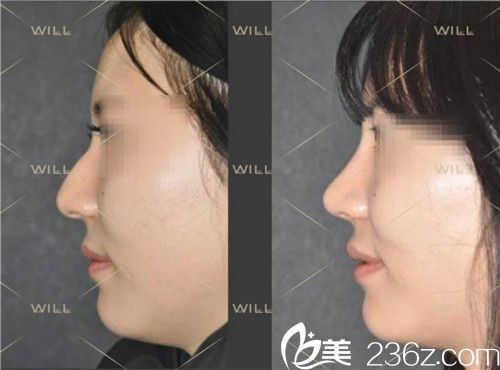 will醫(yī)院硅膠隆鼻整形案例術(shù)前術(shù)后對比