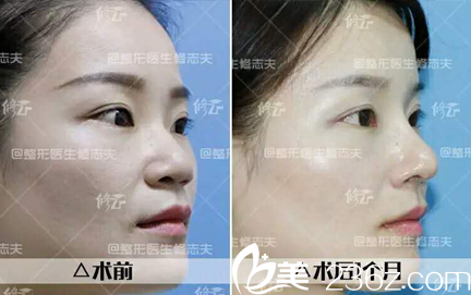 廈門修志夫鼻翼過大，鼻梁低——鼻綜合整形
