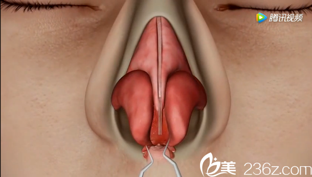 韓國(guó)will醫(yī)院駝峰鼻矯正—分離出一個(gè)完整的鼻部腔隙