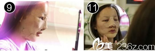 凱莉在廣州華美醫(yī)院做雙眼皮手術(shù)后的恢復(fù)圖 凱莉在廣州華美醫(yī)院做雙眼皮手術(shù)后的恢復(fù)圖