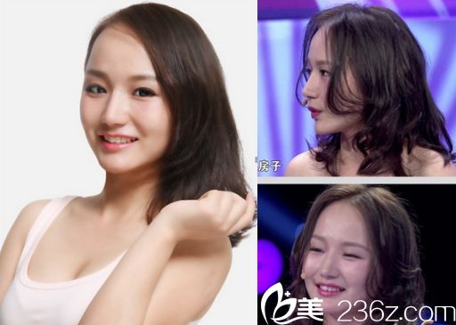 凱莉在廣州華美醫(yī)院阮慶玲醫(yī)生手下做雙眼皮手術(shù)后恢復(fù)后的圖片 凱莉在廣州華美醫(yī)院阮慶玲醫(yī)生手下做雙眼皮手術(shù)后恢復(fù)后的圖片