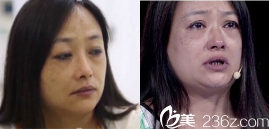 廣州華美易陽亮做激光美白手術前2