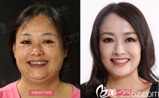廣州華美易陽亮做激光美白手術后的對比圖