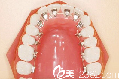 舌側(cè)牙套