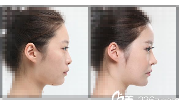假體隆鼻效果對(duì)比圖