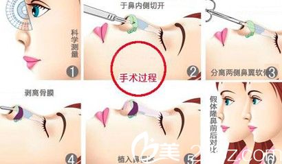 假體隆鼻手術(shù)過(guò)程示意圖