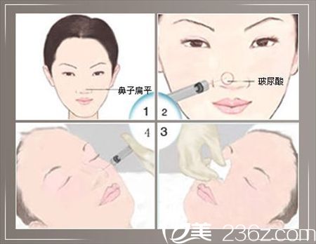 注射玻尿酸隆鼻過(guò)程示意圖