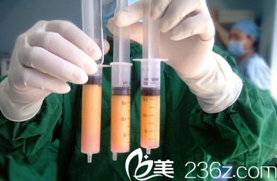 自體脂肪隆鼻材料脂肪