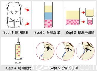 自體脂肪的提取過程
