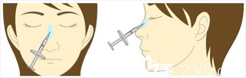 玻尿酸注射隆鼻