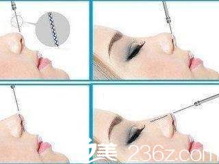 misko線(xiàn)雕隆鼻