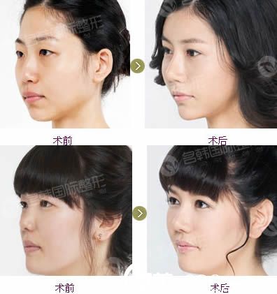 卓敬錫假體隆鼻案例圖