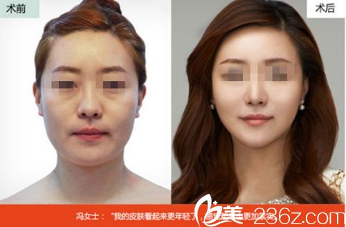 沈陽名流線雕提升案例.jpg 沈陽名流線雕提升案例.jpg