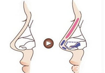 假體隆鼻-假體所放置的位置