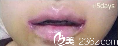 案例拆線后