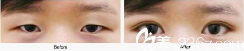 洪政槿雙眼皮整形案例