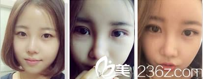 洪政槿雙眼皮案例圖