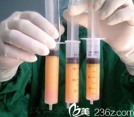 分離出來(lái)的大腿脂肪 分離出來(lái)的大腿脂肪