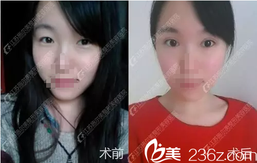 雙眼皮加開眼角前后對比案例