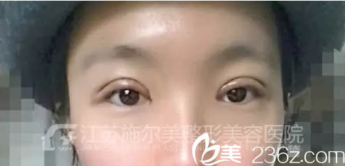 江蘇施爾美雙眼皮術后天效果