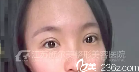 術后第六天雙眼皮加開眼角還在恢復中