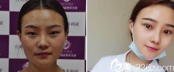 常文彥醫(yī)生的鼻綜合<span style= 常文彥醫(yī)生的鼻綜合<span style=