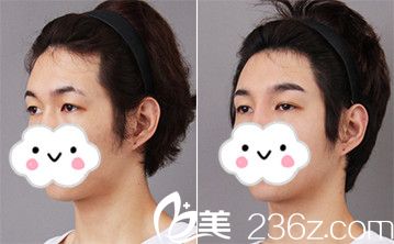 韓式三點(diǎn)雙眼皮前后對(duì)比案例