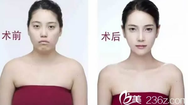 李益準無創(chuàng)塑形案例圖