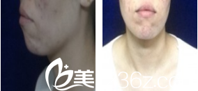 <!--<i data=20240703-sp></i>--><!--<i data=20240703-sp></i>-->墊下巴案例術(shù)前 <!--<i data=20240703-sp></i>--><!--<i data=20240703-sp></i>-->墊下巴案例術(shù)前