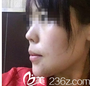 <!--<i data=20240703-sp></i>-->王金燦案例墊下巴術(shù)后效果 <!--<i data=20240703-sp></i>-->王金燦案例墊下巴術(shù)后效果