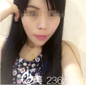 王新燦院長做硅膠假體墊下巴真人記錄