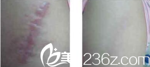 運用美學理念祛疤 運用美學理念祛疤