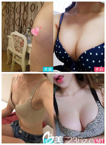 石家莊藍山整形隆胸案例 石家莊藍山整形隆胸案例