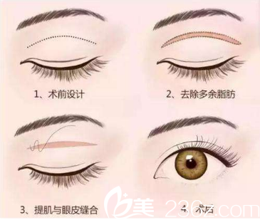 北京米蘭柏羽麗都整形醫(yī)院切開雙眼皮示意圖
