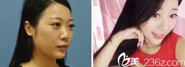 艾長安醫(yī)生的鼻綜合整形<span style=