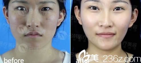 李陽雙眼皮案例圖